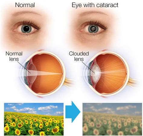 What Causes Cataracts Glaucoma And Macular Degeneration